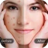 Face Blemish Remover