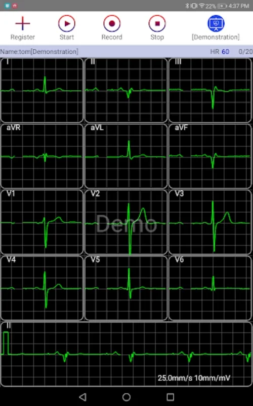 aECG for Android: Real-Time ECG Monitoring & Cloud Storage