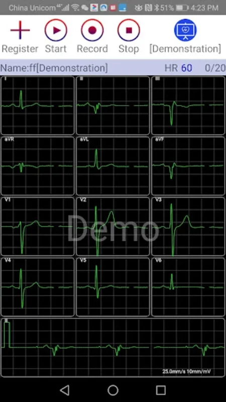 aECG for Android: Real-Time ECG Monitoring & Cloud Storage