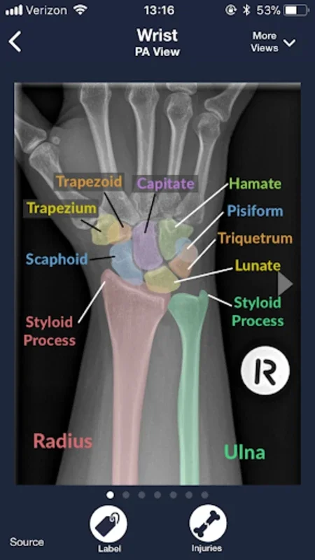 Sublux for Android - Empowering X-ray Interpretation