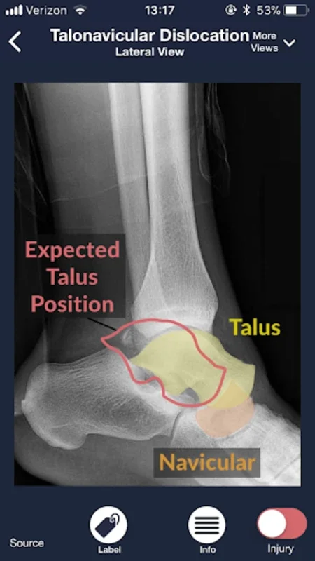 Sublux for Android - Empowering X-ray Interpretation