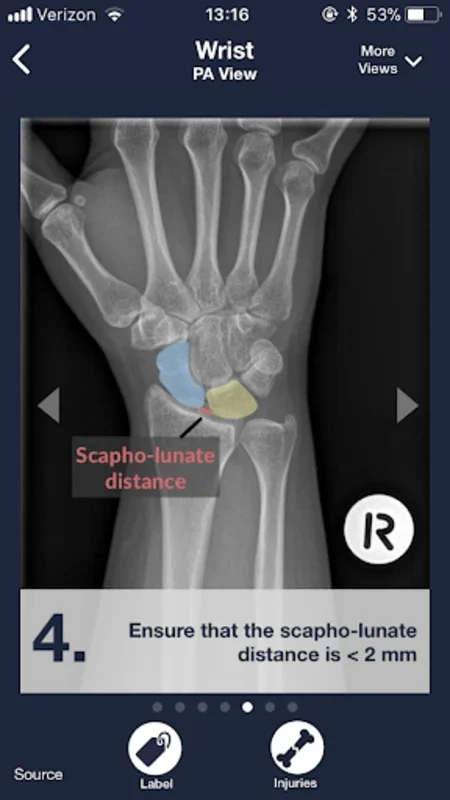 Sublux for Android - Empowering X-ray Interpretation